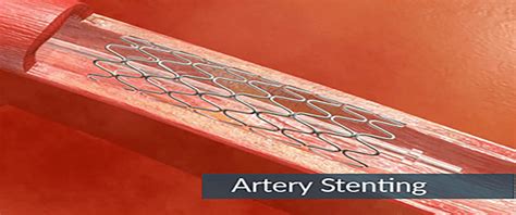 Benefits Of Endovascular Repair With A Stent Graft Dr Abhilash