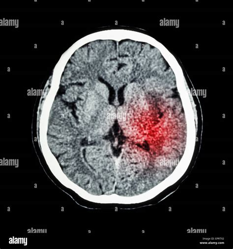 Hemorrhagic Stroke Ct Scan