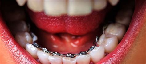 Lingual Braces – ELITE ORTHODONTICS