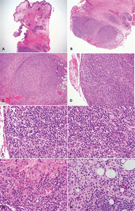 Histopathology Of Case 1 A And B Punch Biopsy Low Power View · 20