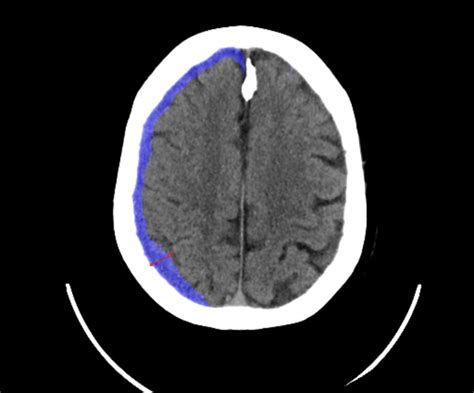 Sdh Image For Blog Neurosurgeons Of New Jersey