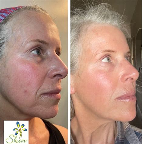 Opus Plasma Skin Resurfacing Skin Essentials