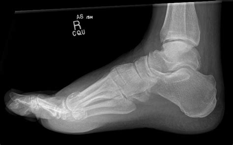 Fractured Lateral And Bipartite Medial Hallux Sesamoid Bones Image