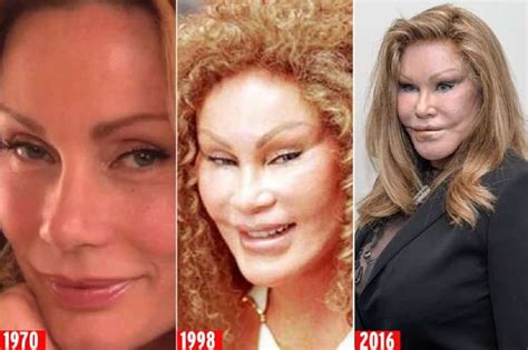 Cat Lady Plastic Surgery Before After: What Happened?