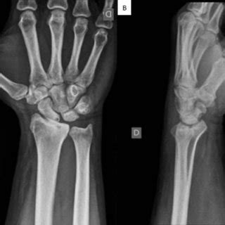 Radiografias Em Posteroanterior A E Perfil B Da Por O Distal Do