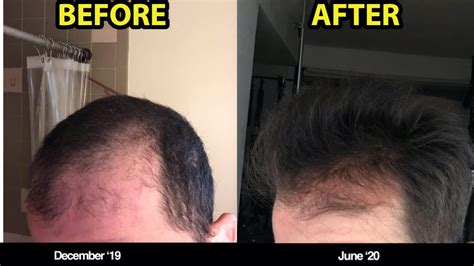 1 Reason Why You Should Be Microneedling For Hair Loss Beforeafter