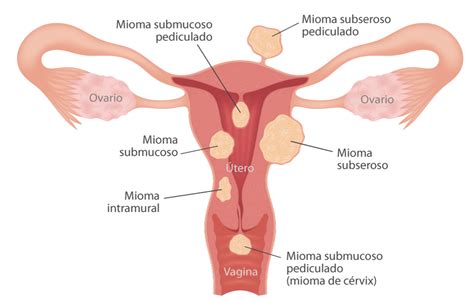 Miomas Uterinos Embolización De Miomas Uterinos Servei