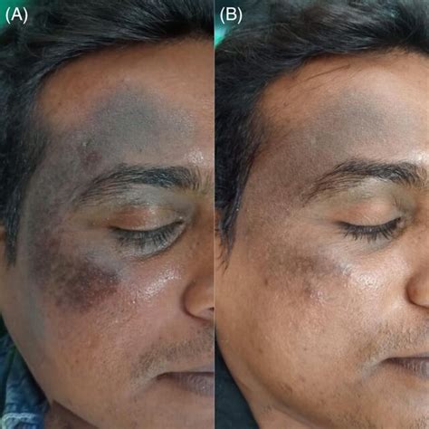 A 30 Year Old Female Patient With Bilateral Nevus Of Ota A At