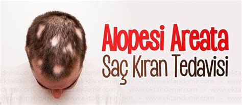 Alopesi Areata Saç Kıran Dermatolog Dr Ektan Demir