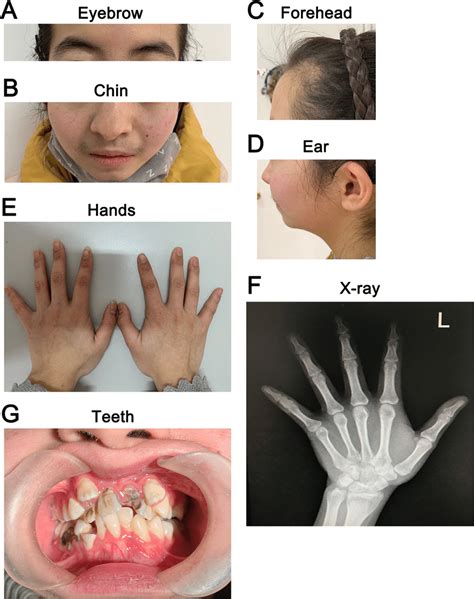 Image Of The Patient A B C D Facial Abnormalities Included