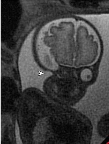 Mr Imaging Of The Fetal Face Comprehensive Review Radiographics