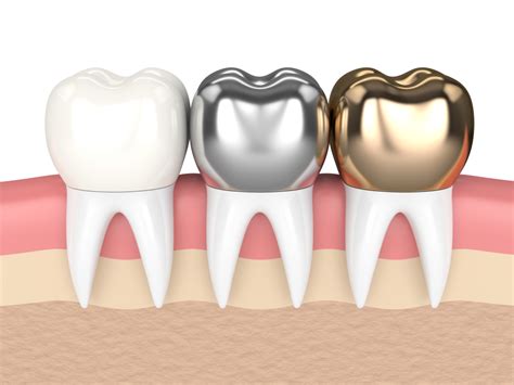 All About Dental Crown Types Pittsburgh Dentist