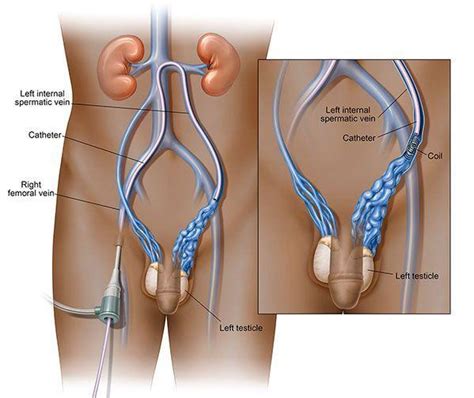 Embolization Versus Surgery For Treatment Of Varicocele Vascular And