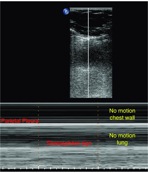 Pneumothorax In M Mode Parietal Pleura Visualized Below Two Successive