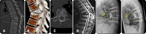 Figure 1 From Thoracoscopically Assisted Vertebral Reconstruction