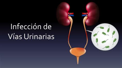 Infección de vías urinarias Medicoblastita uDocz