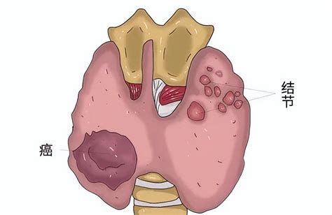 甲状腺结节是气出来的病吗？代谢影响女性