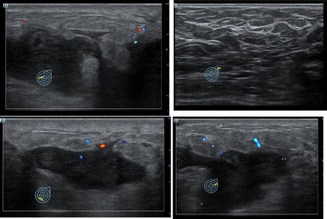 Granulomatous Mastitis Radiology Cases