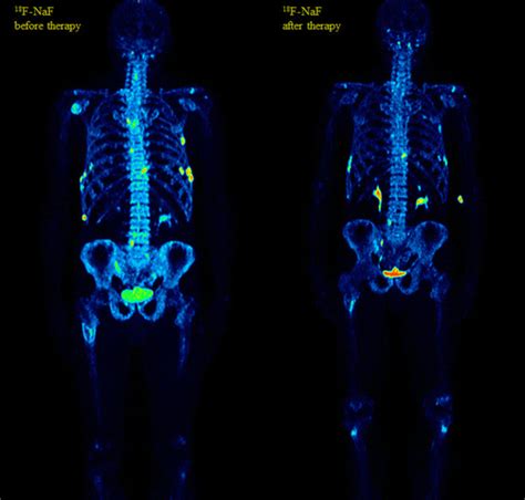 Whole body ¹⁸F NaF PET CT MIP before and after therapy of the same