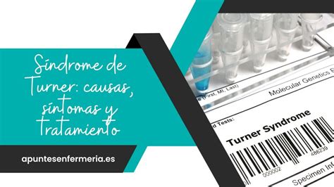 Síndrome de Turner causas síntomas y tratamiento Apuntes enfermería