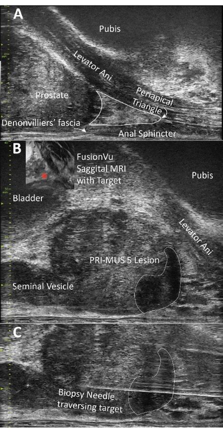 Micro Ultrasound Guided Transperineal Prostate Biopsy A Clinic Based Procedure Scientific