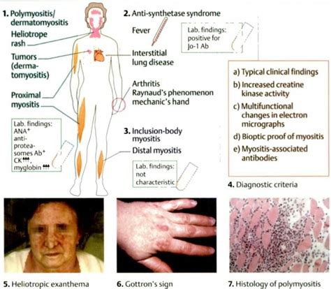 Pin On Rheumatology