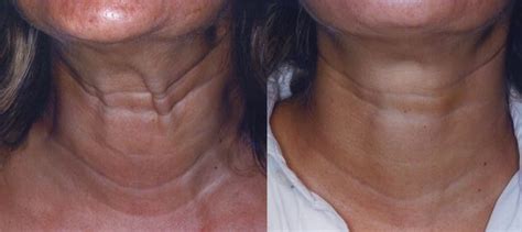 Thyroid Itching Pictures Photos