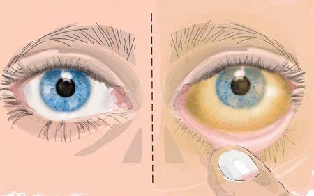 Leberfibrose Symptome Behandlung Prognose