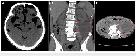 Pdf Pneumocephalus After Anterior Lumbar Spinal Surgery Due To Trauma