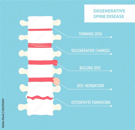 Degenerative disc disease. Spinal arthritis. Vertebral hernia Stock Vector | Adobe Stock