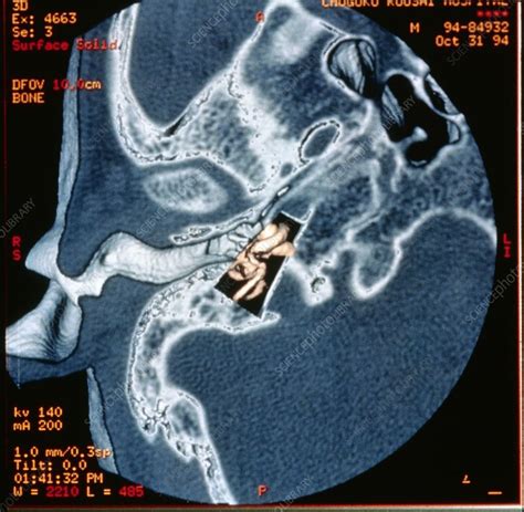 Ear Anatomy Ct Scan at Arnulfo Levitt blog