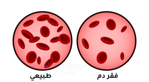 فقر الدم عند الأطفال أعراضه و طرق لعلاجه 2024