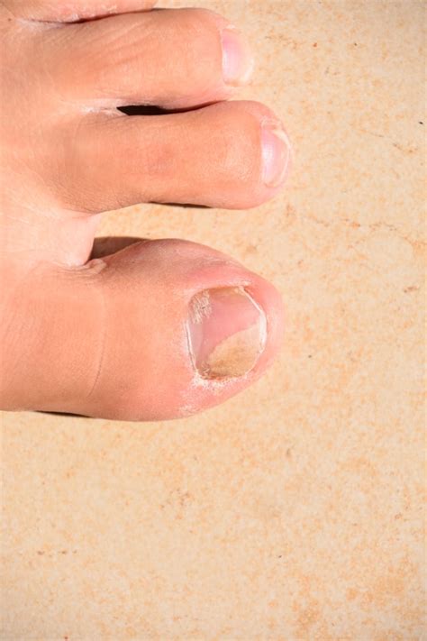 White Toenails Symptom