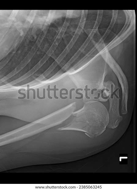 Detailed Xray Surgical Neck Humerus Fracture Stock Photo 2385063245 | Shutterstock