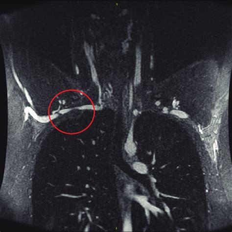 Mra Chest Showing Compression Of The Subclavian Artery Download Scientific Diagram