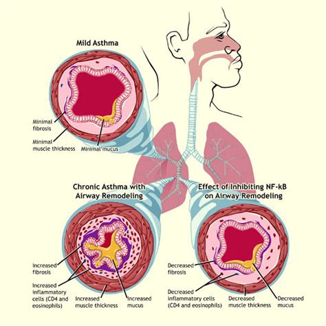 Asthma Airway Inflammation