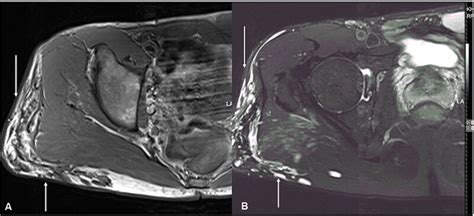 Axial T1 Weighted And T2 Weighted Fat Saturated Magnetic