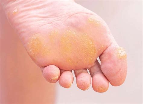 How To Get Rid Of Callus On Foot Online