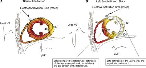 Left Bundle Branch Block And Cardiac Resynchronization Therapy