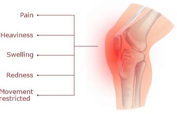 Knee Effusion – Pain Free Joint