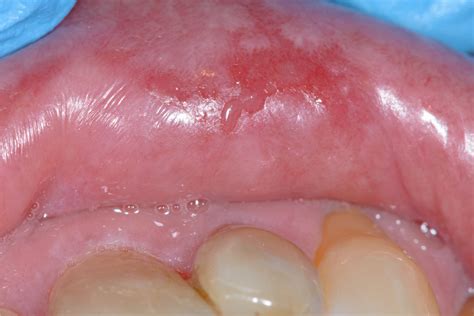 Oral Lichen Planus And Related Lesions What Should We Accept Based On