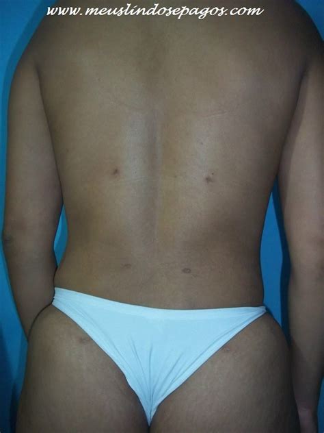 Meus Lindos E Pagos Arquivos Abdominoplastia Lipoaspira O