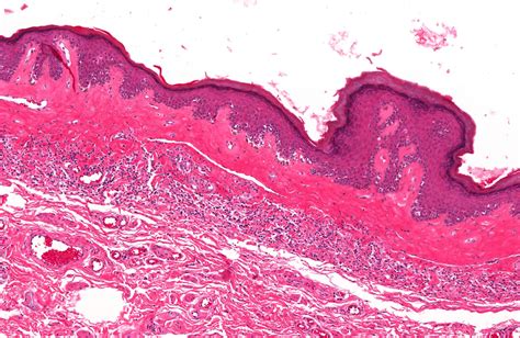 Balanitis Xerotica Obliterans Histology