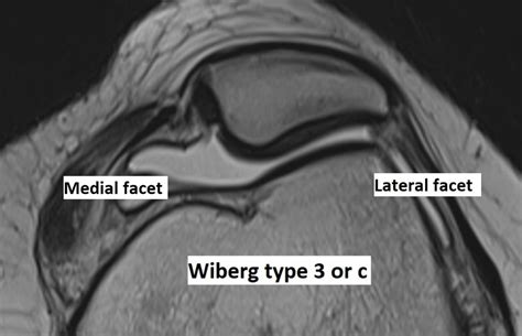 Patella Typ Wiberg 3 Captions Ideas