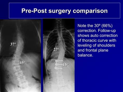 Case Review C Adolescent Idiopathic Scoliosis Ppt