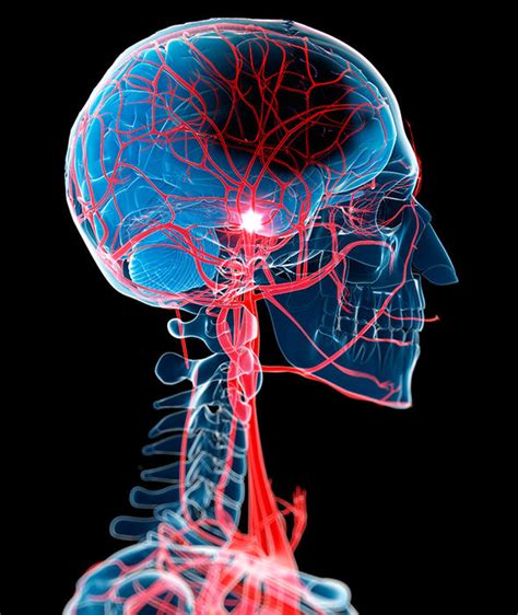 Mini stroke symptoms: Seven signs of a TIA that indicate you’re at risk of having a stroke ...