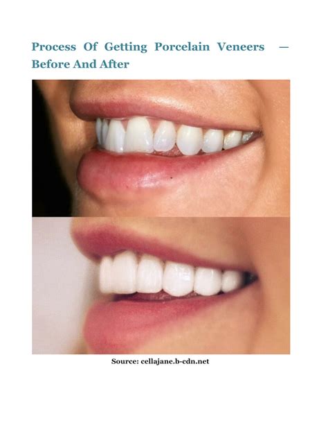 Ppt Porcelain Veneers Before And After Process Benefits Cost