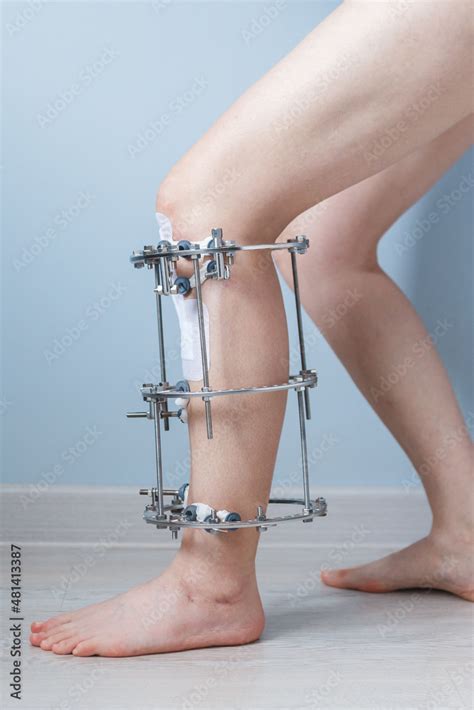 Leg In Ilizarov S External Fixator Ilizarov S Apparatus Stock Photo