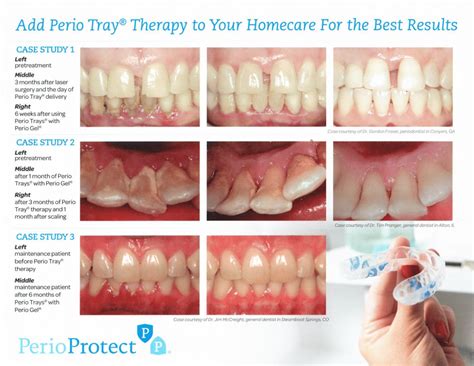 Gum Disease Before And After