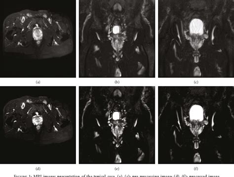 Figure 1 From Super Resolution Reconstruction Algorithm Based Mri